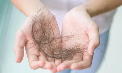 How to Stop Hair Loss from Ulcerative Colitis