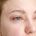 What Causes Itchy Eyes Besides Allergies