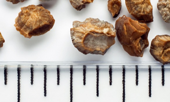 How Long Does it Take to Pass a Kidney Stone?
