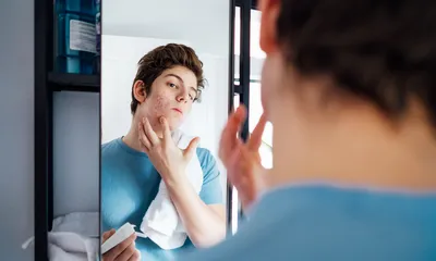 Is Vanicream Good for Acne