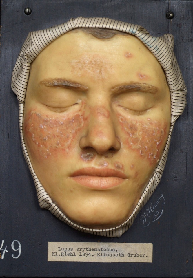 Lupus article