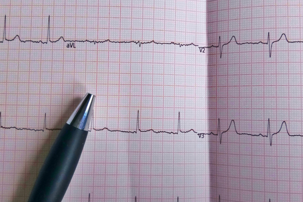 ECG