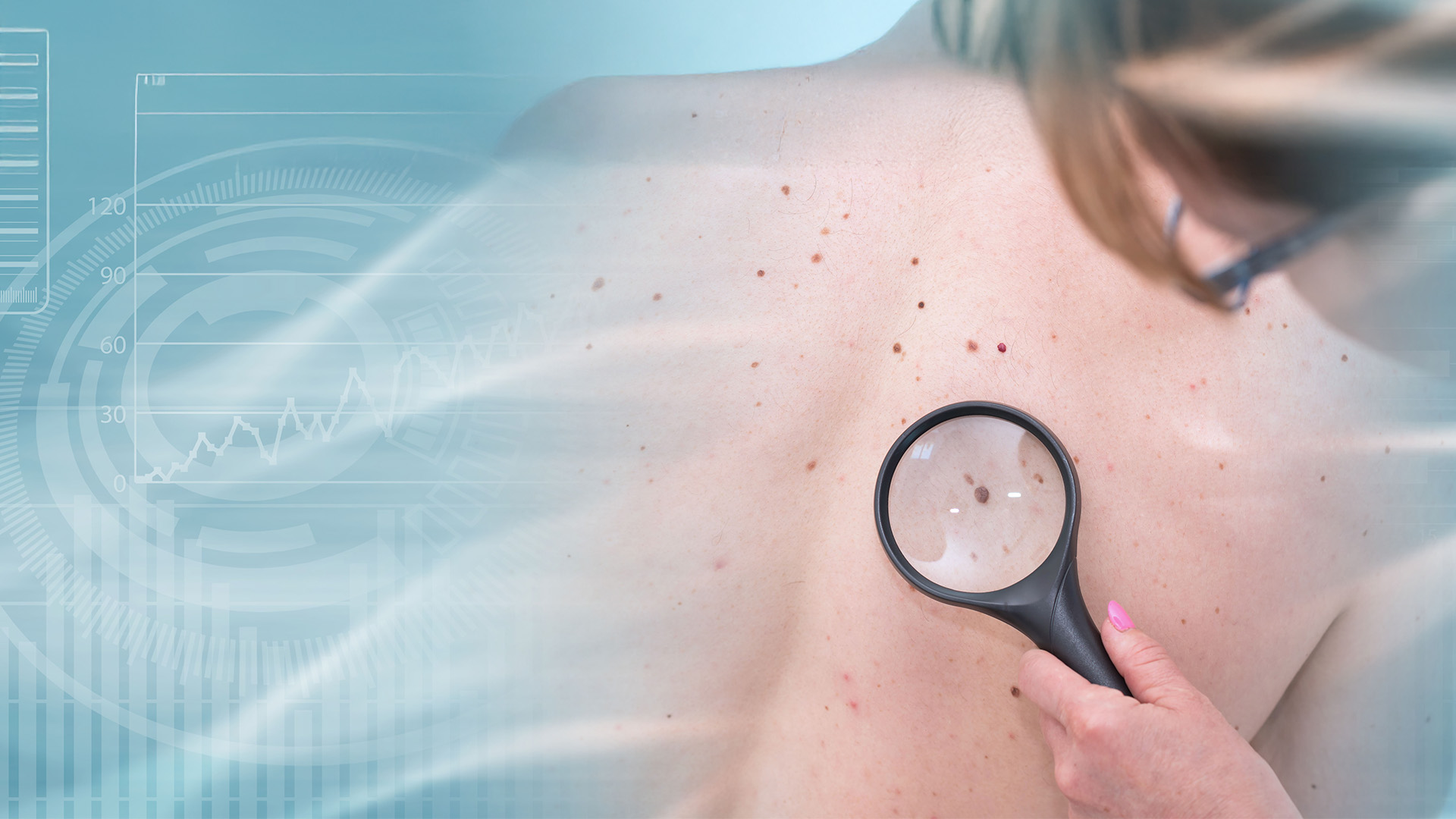 Melanoma