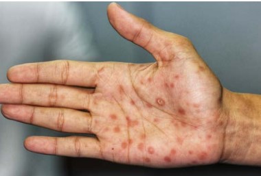 Syphilis Lesions
