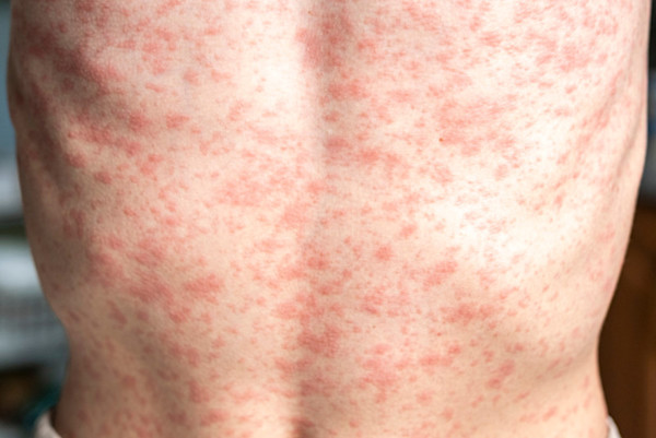 Image 1: Confluent maculopapular measles rash on the torso. Measles article June 2026 Pathology Focus.
