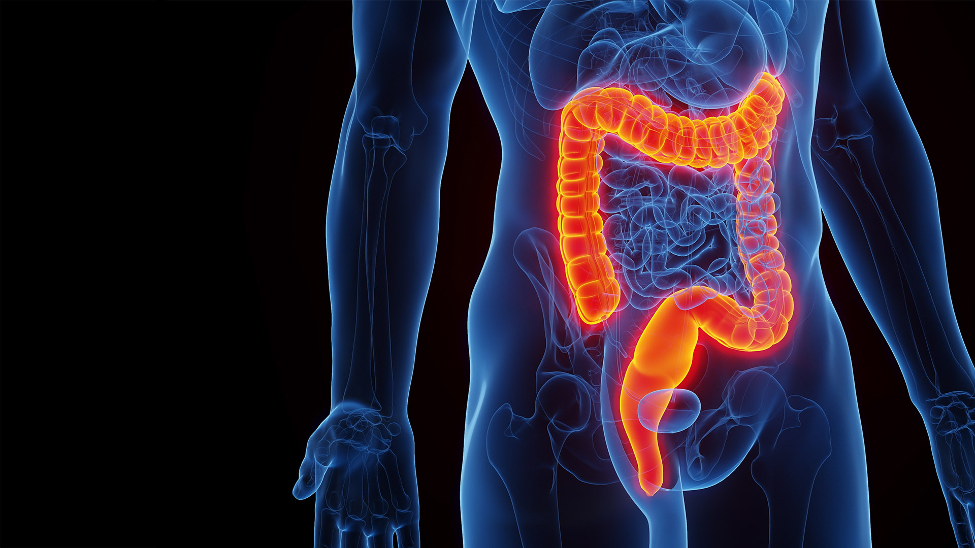Colorectal Cancer