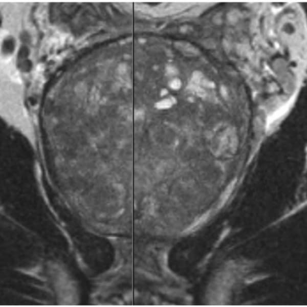 前立腺肥大のMRI画像