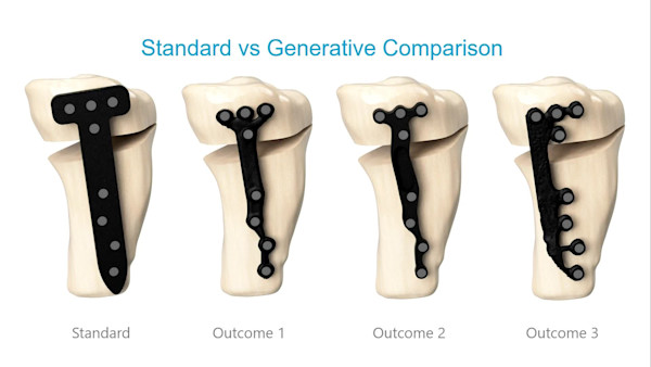 Future of Fracture Fixation: A Generative Design Approach to Surgical Implants