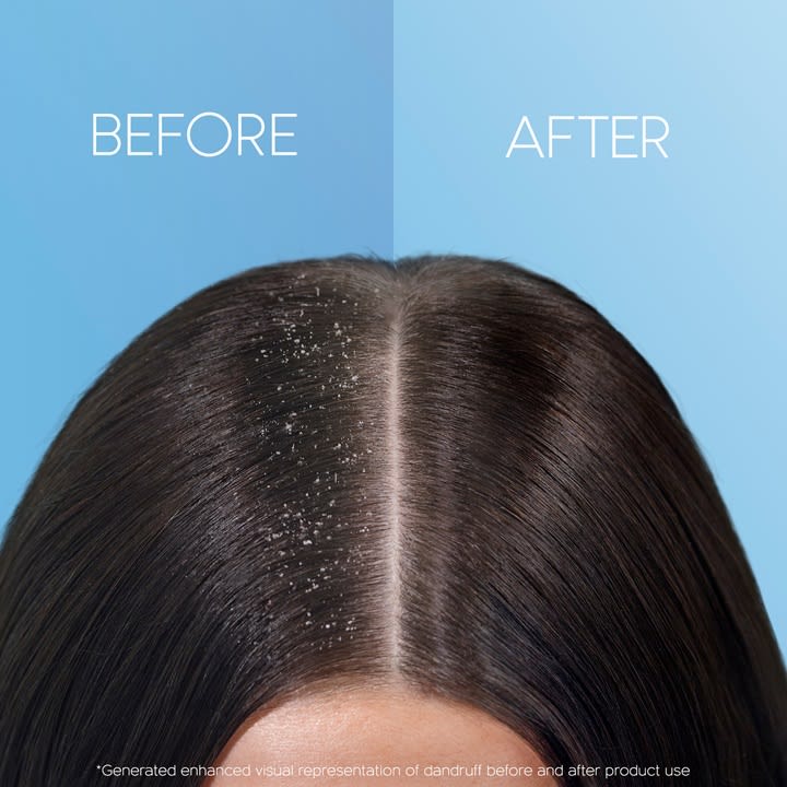 How to Get Rid of Dandruff from Hair? | Head & Shoulders AU