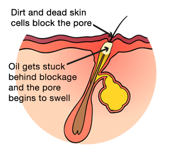 Diagram of Clogged Pore