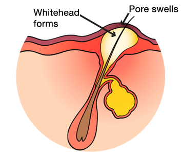 Diagram of whitehead spot