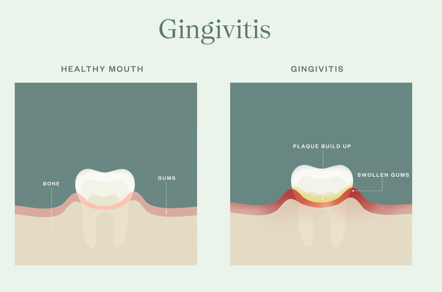 Gingivitis What You Need To Know Tend