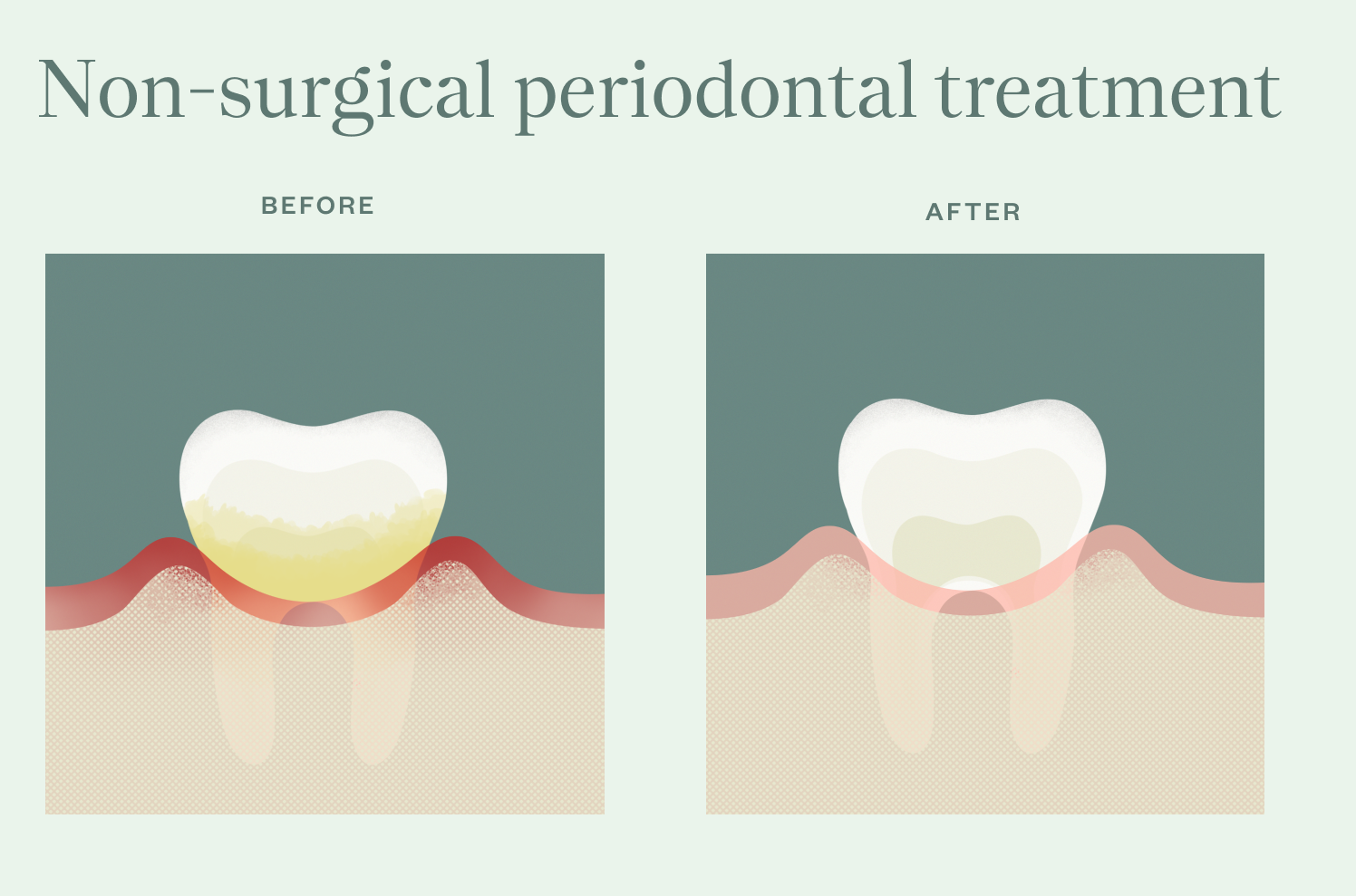 Periodontitis: What It Is and How It's Treated