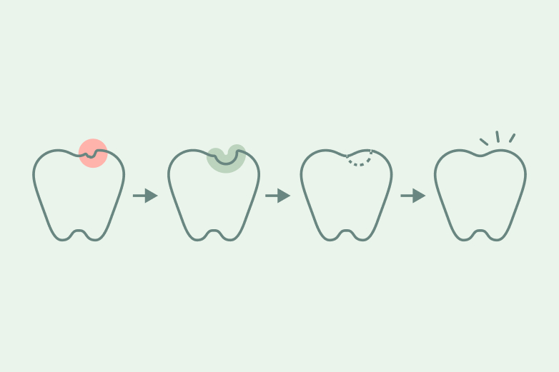 What Do You Need To Know About White Fillings?