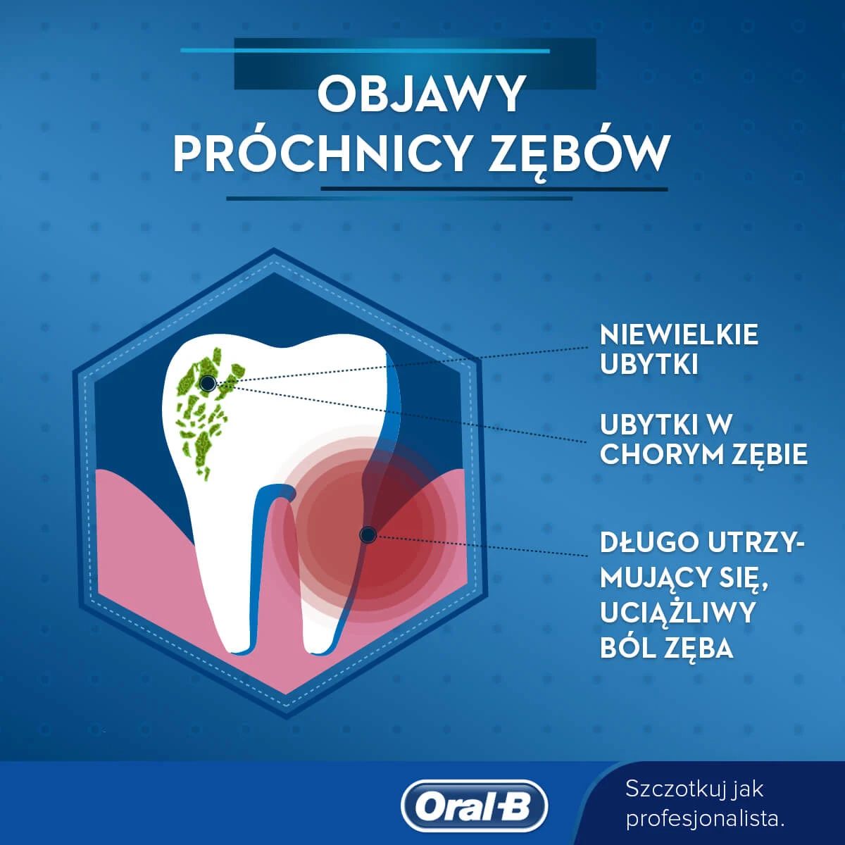 Co to jest próchnica zębów? Leczenie, oznaki i objawy