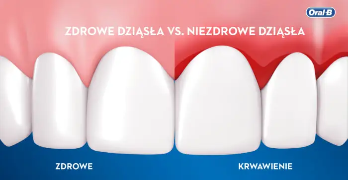 Co należy wiedzieć o zapaleniu dziąseł 