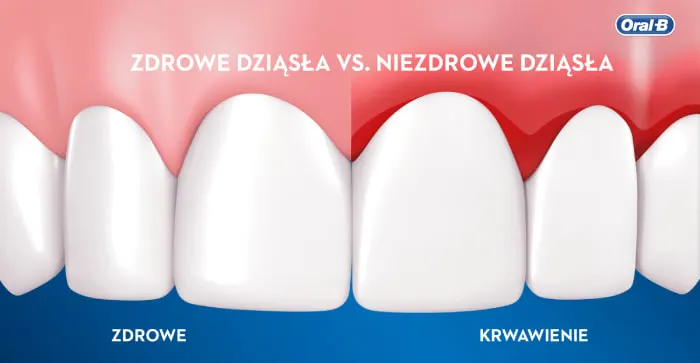 Co należy wiedzieć o zapaleniu dziąseł