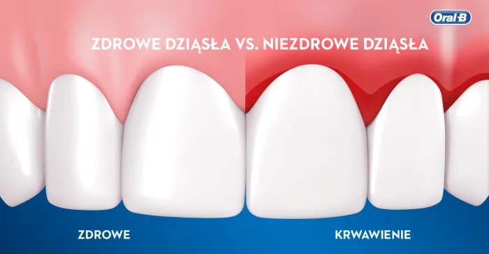 Co należy wiedzieć o zapaleniu dziąseł