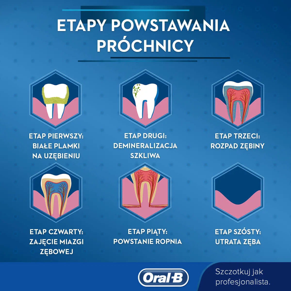 Kolejne etapy próchnicy