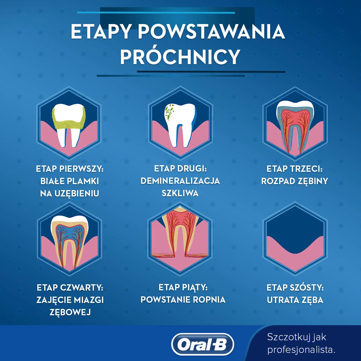 Kolejne etapy próchnicy