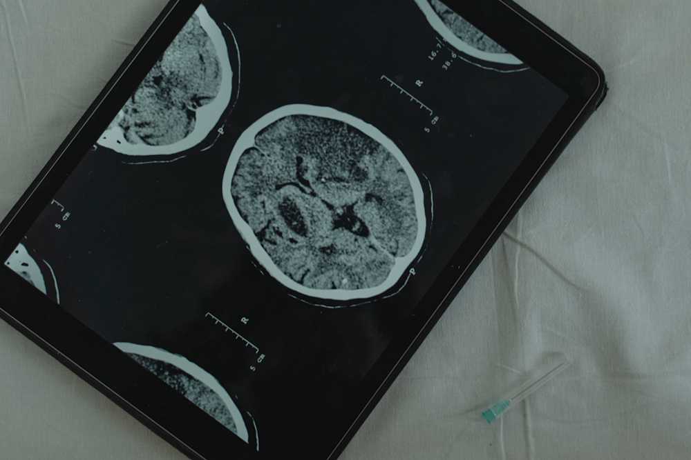 scan of a brain shown on tablet