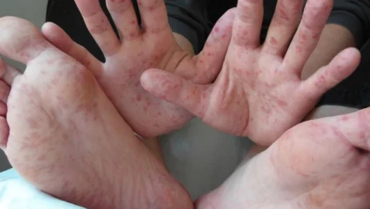 Región San Martín en alerta epidemiológica por la enfermedad de mano, pie y boca