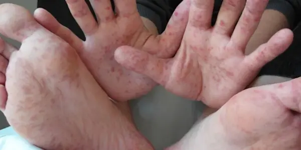 Región San Martín en alerta epidemiológica por la enfermedad de mano, pie y boca