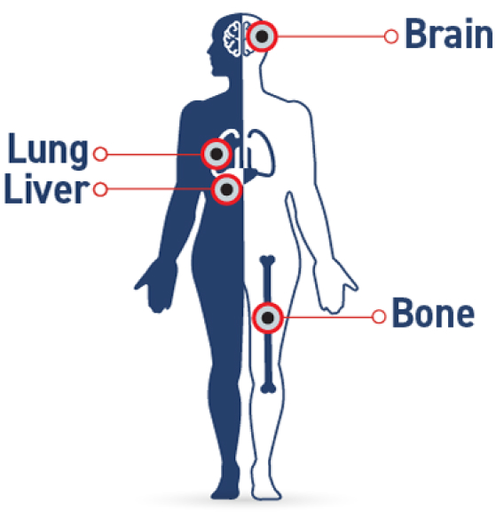 Sites of recurrence for patients with EBC include bone, liver, lungs, and brain.