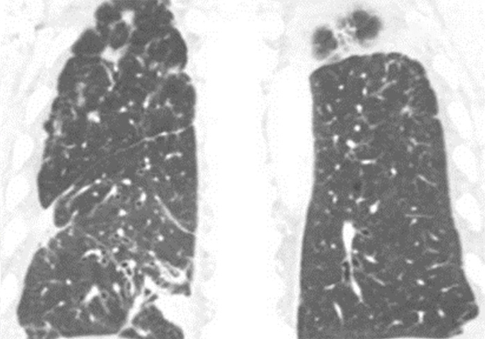 CT scan of patient after treatment