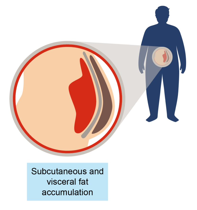 Accumulation of visceral and subcutaneous fat leads to obesity.