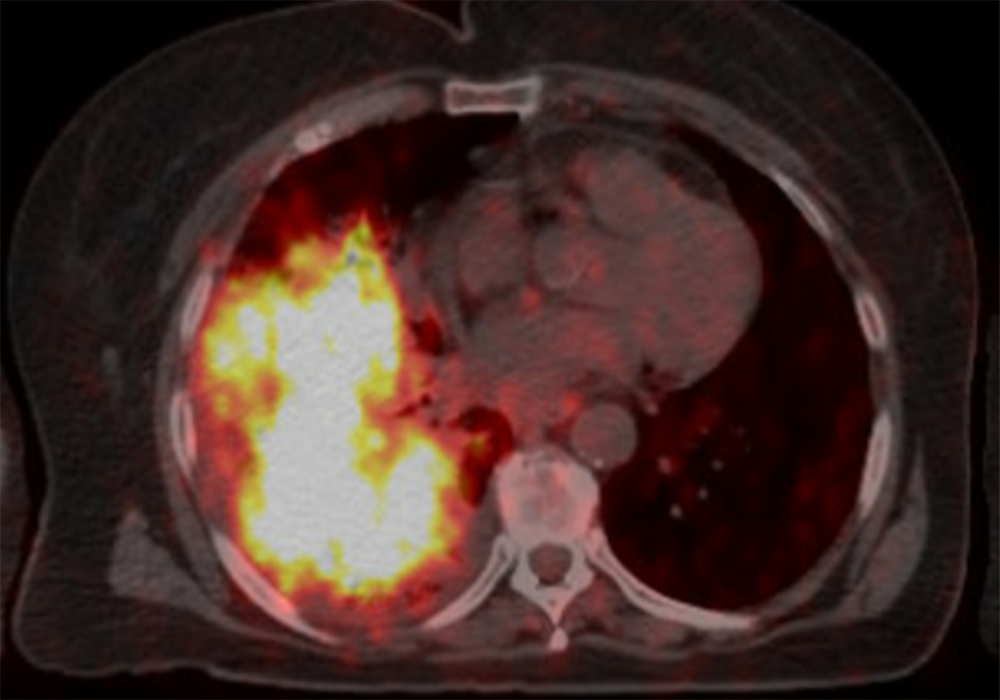 PET scan of patient before treatment