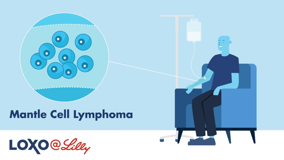 Mantle Cell Lymphoma