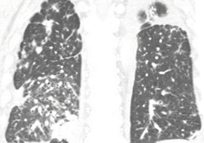 CT scan of patient before treatment