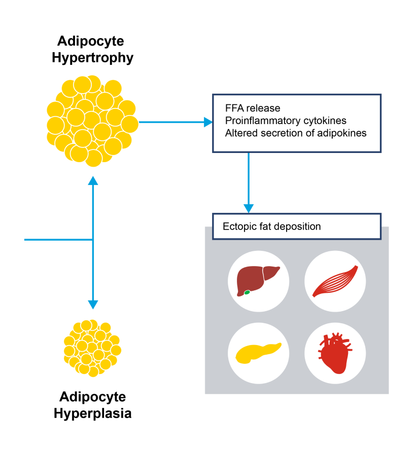 Increased lipid storage in adipocytes leads to adipocyte hypertrophy and dysfunction, leading to increased circulating lipids.