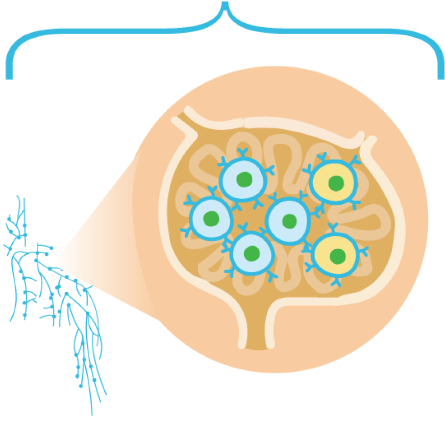 Lymph node with higher proportion of abnormal compared to healthy B cells