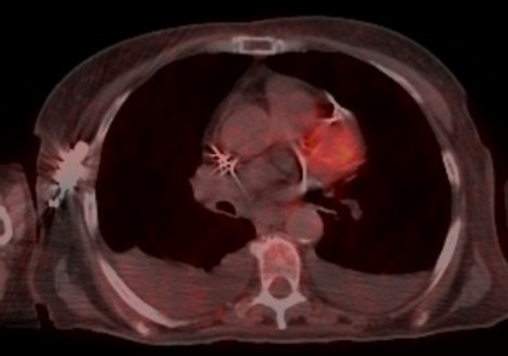 PET scan of patient after treatment