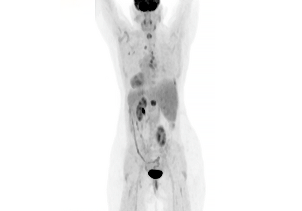 PET scan of patient before treatment (side view)