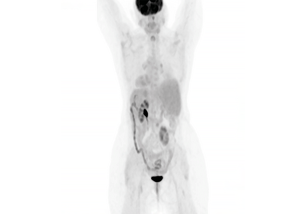 PET scan of patient after treatment (front view)