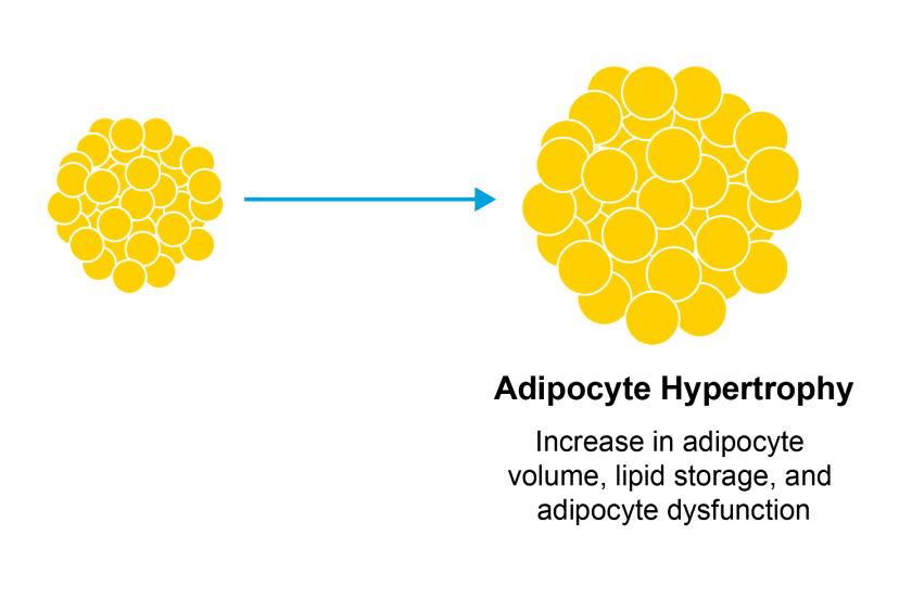 Adipocyte hypertrophy leads to visceral and subcutaneous fat accumulation.