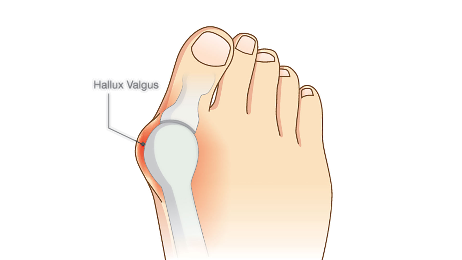Yoga for Bunions, Toe, Ankle & Foot Tension 