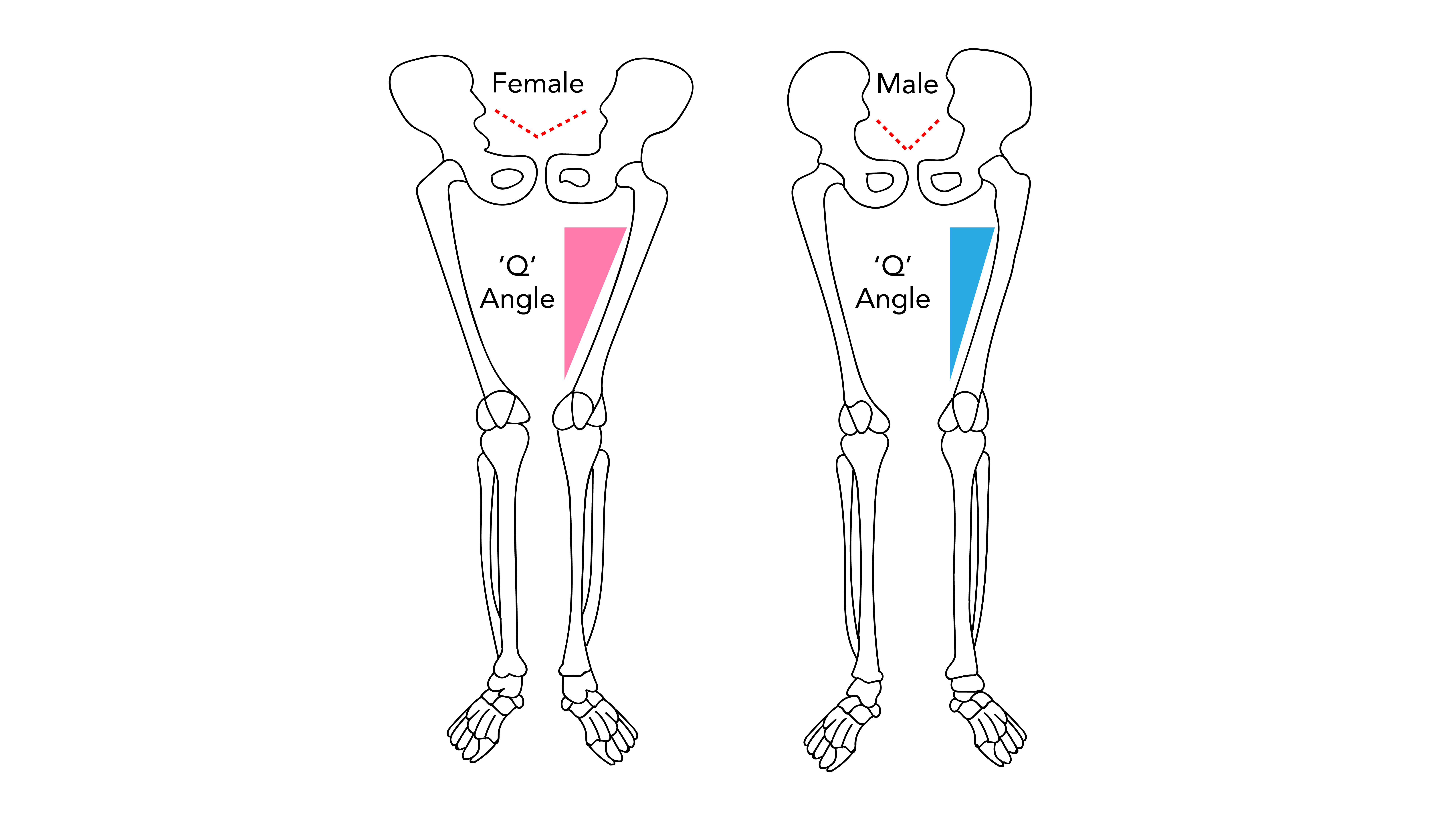 A Leg-Activating Sequence to Address Common Misalignments