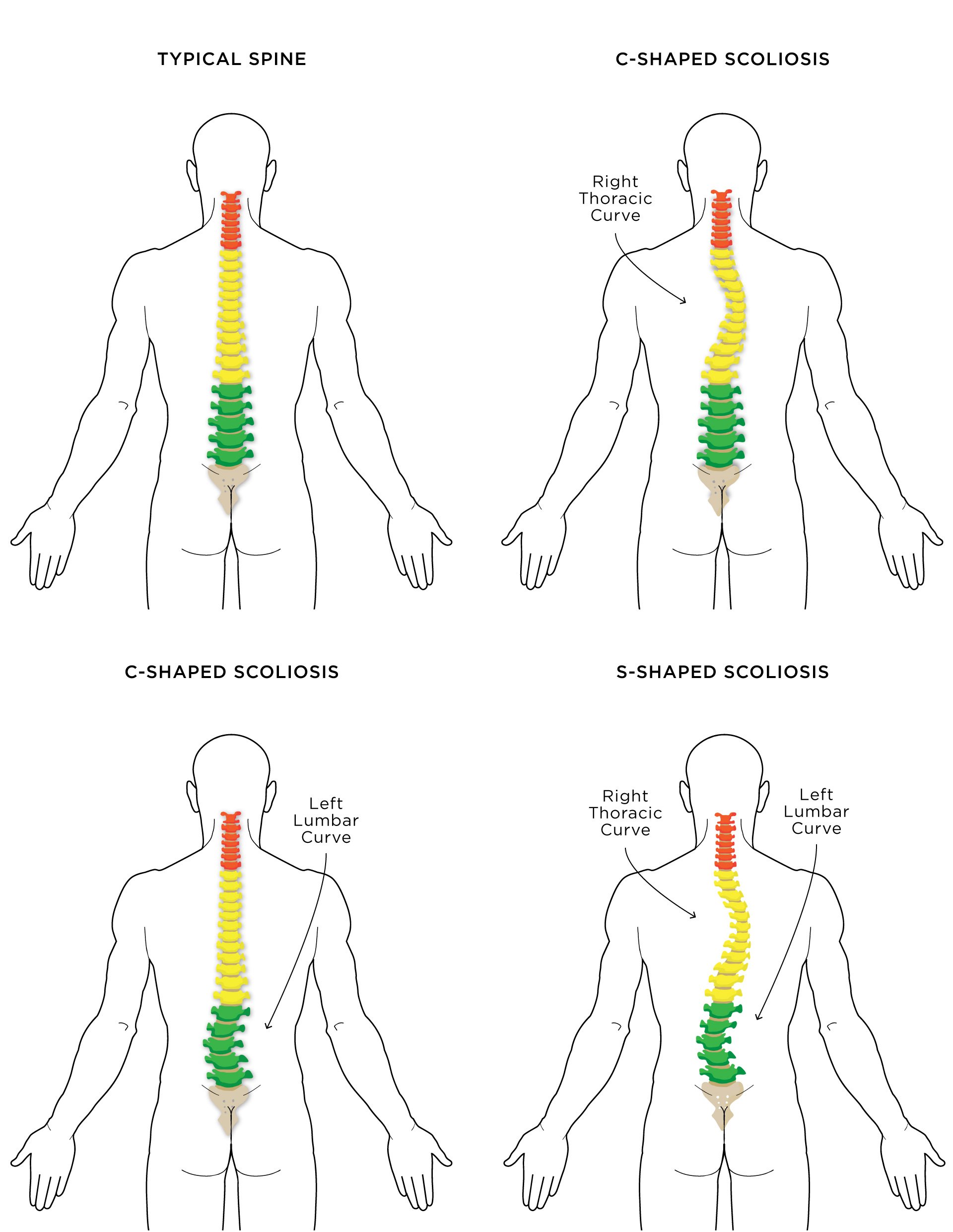Scoliosis And Yoga The Do S And Don Ts