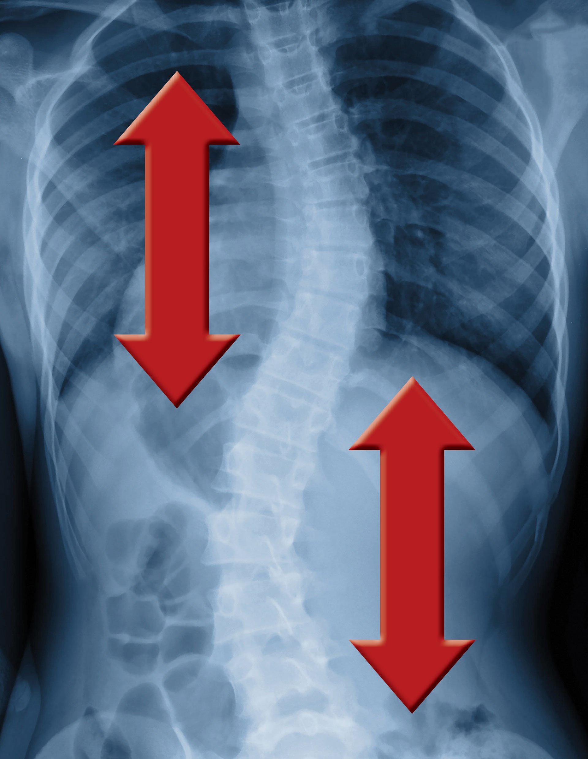 Tips for side sleeping with Scoliosis 