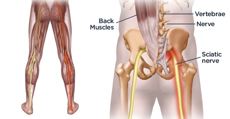 Sciatic nerve pain symptoms and exercises for runners