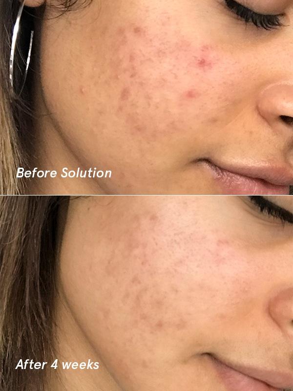 glossier acne serum