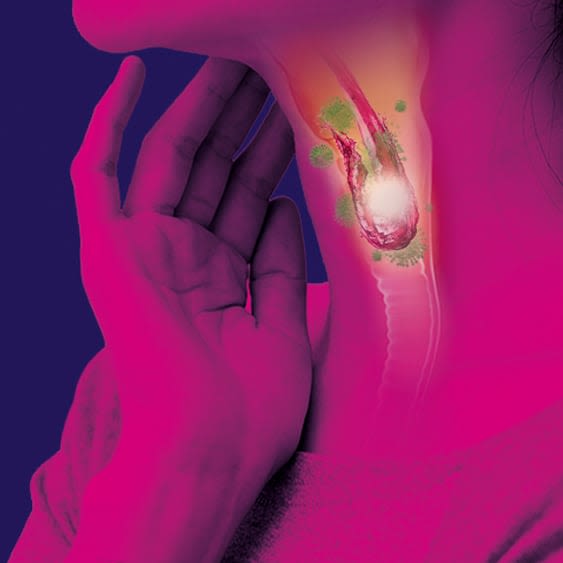 What is Sore Throat?
