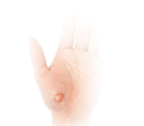 yakedo_hand
