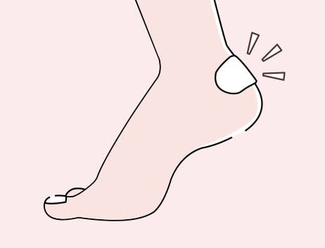 靴ずれ　治りかけの再発予防も肝心