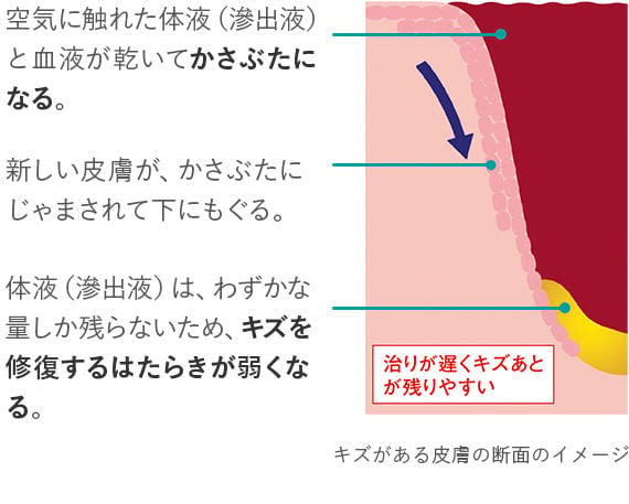 ドライトヒーリング