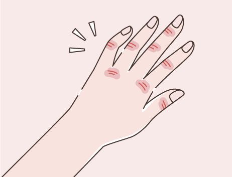 あかぎれ 治りにくく繰り返し起きやすいのが特徴